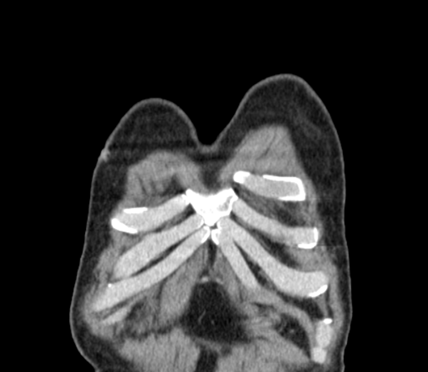 Airway foreign body in adult (Radiopaedia 85907-101779 Coronal liver window 2).jpg