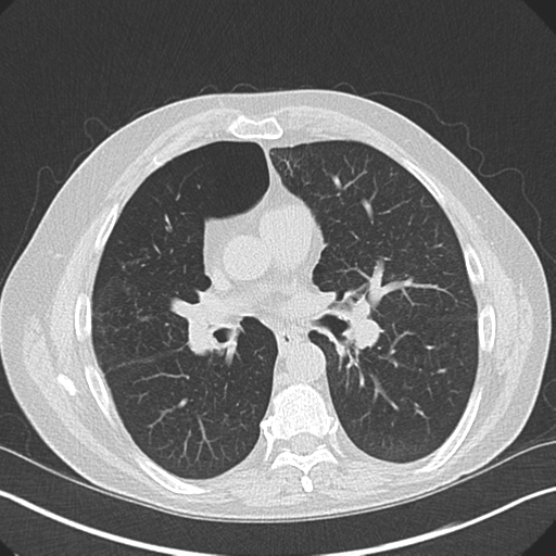 File:Allergic bronchopulmonary aspergillosis (Radiopaedia 44760-48571 Coronal lung window 1).png