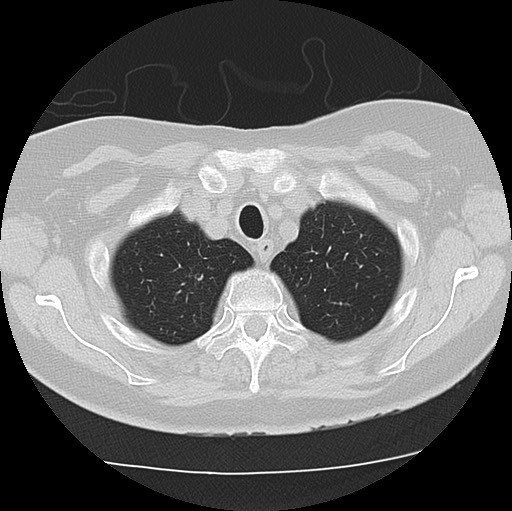 Alpha-1-antitrypsin deficiency (Radiopaedia 72058-82557 Axial lung window 9).jpg