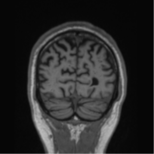 Alzheimer's disease- with Gerstmann syndrome and dressing apraxia (Radiopaedia 54882-61150 Coronal T1 16).png