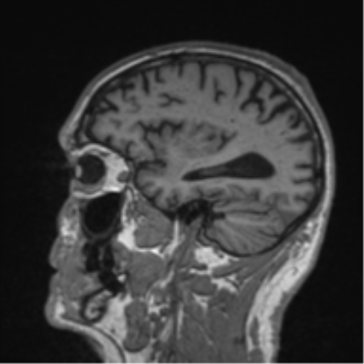 File:Alzheimer's disease- with Gerstmann syndrome and dressing apraxia (Radiopaedia 54882-61150 Sagittal T1 18).png
