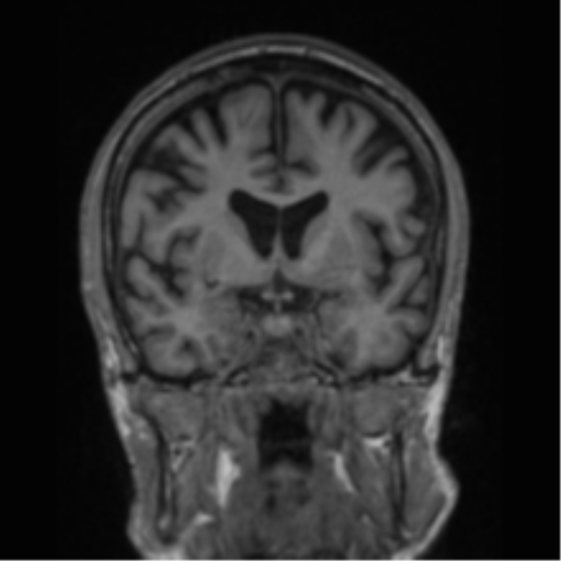 File:Alzheimer's disease- with apraxia (Radiopaedia 54763-61011 Coronal T1 57).png