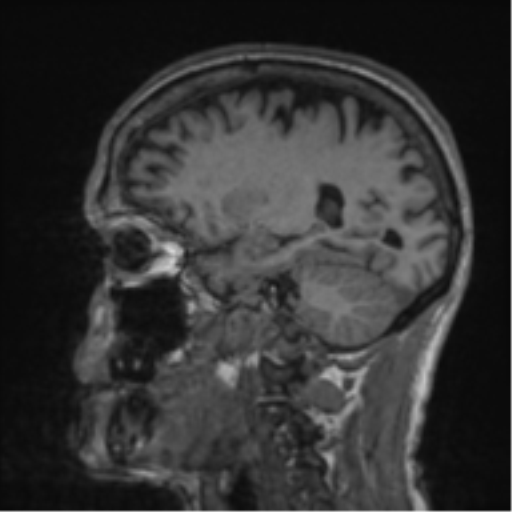 Alzheimer's disease- with apraxia (Radiopaedia 54763-61011 Sagittal T1 24).png