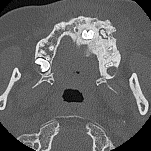 File:Ameloblastic fibro-odontoma (Radiopaedia 18843-18780 C 40).jpg