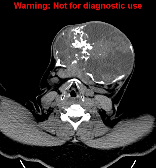 File:Ameloblastoma (Radiopaedia 33126-34164 A 21).jpg