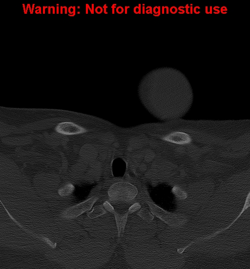 Ameloblastoma (Radiopaedia 33126-34164 Axial bone window 47).jpg
