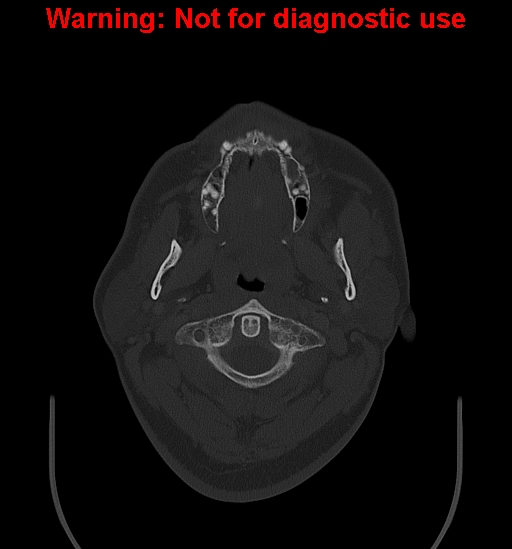 Ameloblastoma (Radiopaedia 33126-34164 Axial bone window 5).jpg