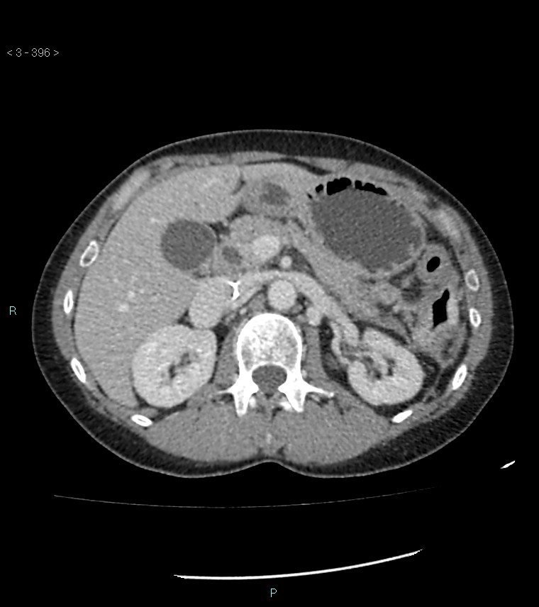 Ampulla of Vater metastasis (Radiopaedia 27820-28069 A 34).jpg