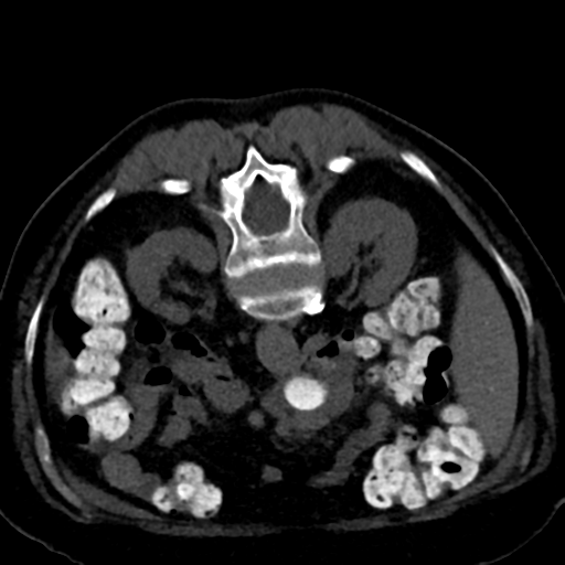 Ampullary adenocarcinoma (Radiopaedia 34013-35241 C 45).png