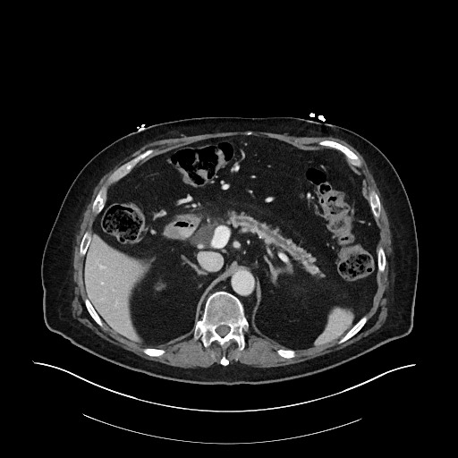 File:Ampullary adenocarcinoma (Radiopaedia 59373-66734 C 50).jpg