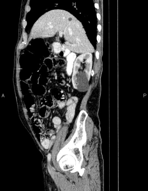 Ampullary adenocarcinoma (Radiopaedia 86093-102032 D 26).jpg