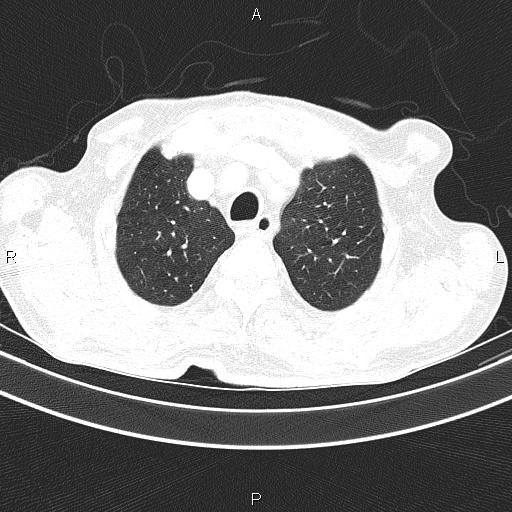 File:Ampullary adenocarcinoma (Radiopaedia 86093-102033 Axial lung window 19).jpg