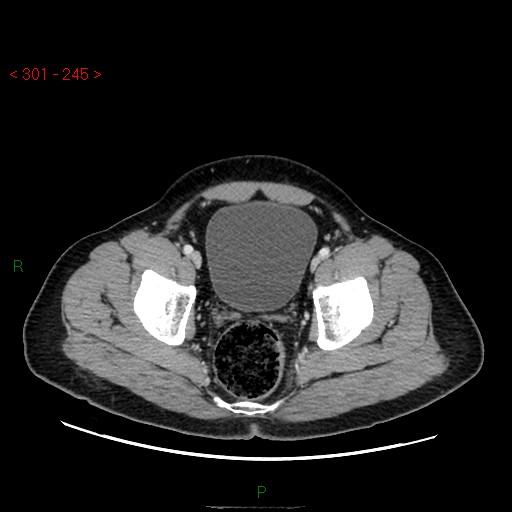 Ampullary carcinoma (Radiopaedia 56396-63056 C 91).jpg