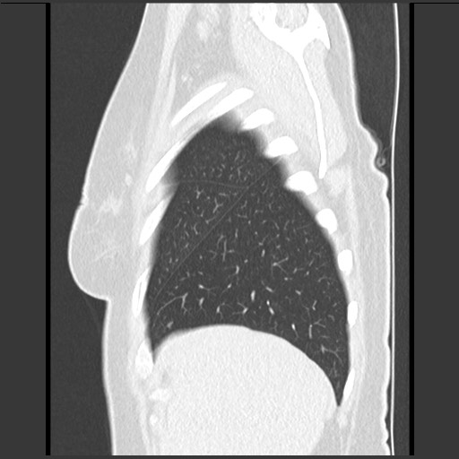 Amyloidosis - bronchial and diffuse nodular pulmonary involvement (Radiopaedia 60156-67744 F 8).jpg