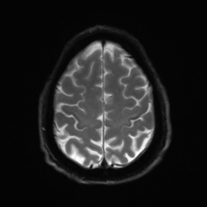 File:Amyotrophic lateral sclerosis (Radiopaedia 87352-103658 Axial DWI 23).jpg