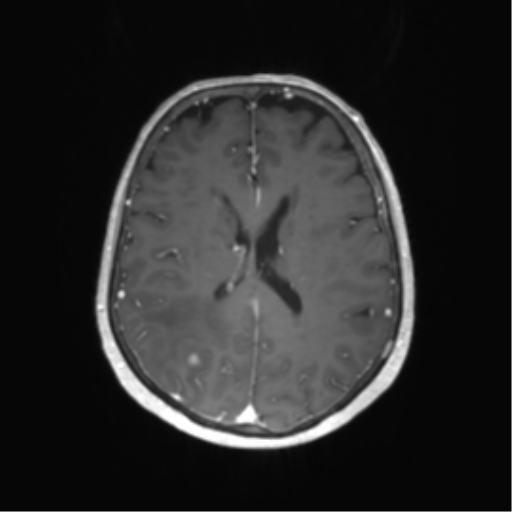 File:Anaplastic astrocytoma (Radiopaedia 86943-103160 Axial T1 C+ 42).png