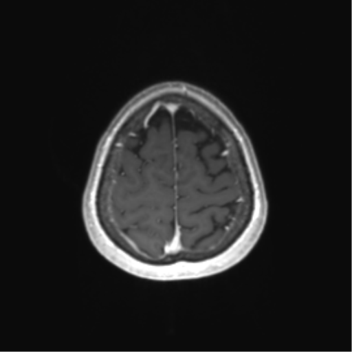 File:Anaplastic astrocytoma (Radiopaedia 86943-103160 Axial T1 C+ 78).png