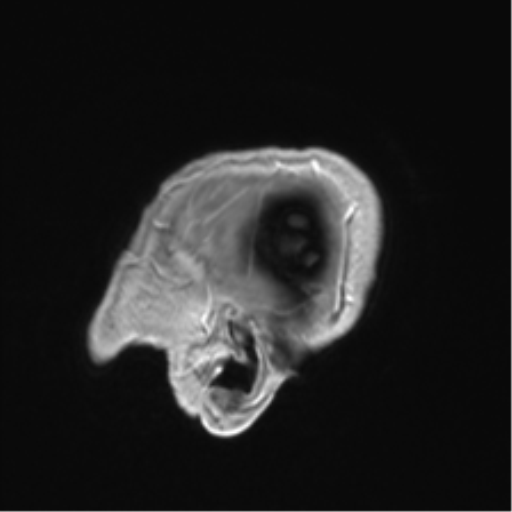 Anaplastic astrocytoma IDH mutant (Radiopaedia 50046-55341 Sagittal T1 C+ 56).png