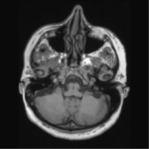 File:Anaplastic astrocytoma IDH wild-type (pseudoprogression) (Radiopaedia 42209-45276 Axial T1 38).png