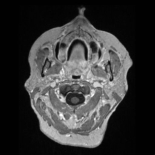 Anaplastic astrocytoma IDH wild-type (pseudoprogression) (Radiopaedia 42209-45276 Axial T1 C+ 2).png