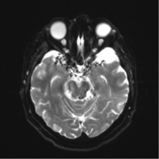Anaplastic astrocytoma IDH wild-type (pseudoprogression) (Radiopaedia 42209-45279 Axial DWI 10).png