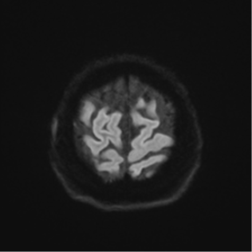 Anaplastic astrocytoma IDH wild-type (pseudoprogression) (Radiopaedia 42209-45279 Axial DWI 51).png