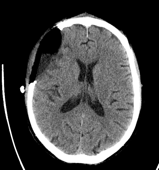 File:Anaplastic meningioma with recurrence (Radiopaedia 34452-35786 Axial non-contrast 19).png