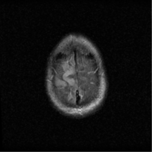 File:Anaplastic meningioma with recurrence (Radiopaedia 34452-35789 Axial FLAIR 22).png