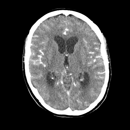 Aneursym related subarachnoid hemorrhage with hydrocephalus (Radiopaedia 45105-49084 D 27).jpg