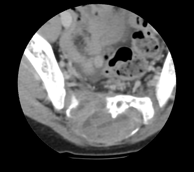 Aneurysmal bone cyst - sacrum (Radiopaedia 65190-74195 Axial non-contrast 30).jpg