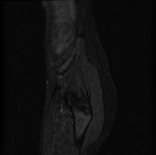 File:Aneurysmal bone cyst - sacrum (Radiopaedia 65190-74196 Sagittal STIR 32).jpg