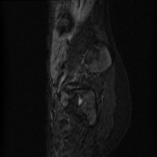 File:Aneurysmal bone cyst - sacrum (Radiopaedia 65190-74196 Sagittal STIR 9).jpg