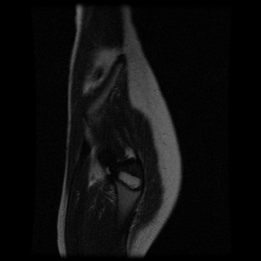File:Aneurysmal bone cyst - sacrum (Radiopaedia 65190-74196 Sagittal T2 1).jpg