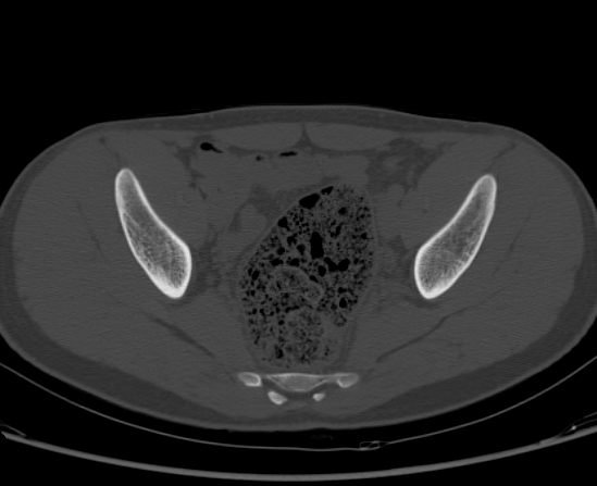 File:Aneurysmal bone cyst of ischium (Radiopaedia 25957-26094 Axial bone window 40).png