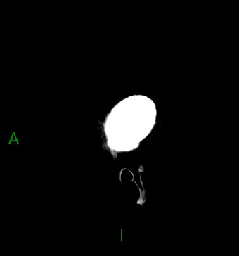 File:Aneurysmal subarachnoid hemorrhage with intra-axial extension (Radiopaedia 84371-99699 B 47).jpg