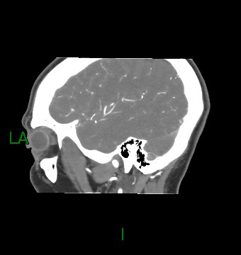 Aneurysmal subarachnoid hemorrhage with intra-axial extension (Radiopaedia 84371-99732 B 14).jpg