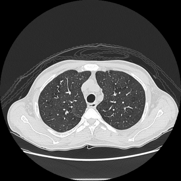 Angioinvasive aspergellosis (Radiopaedia 66995-76315 Axial lung window 11).jpg