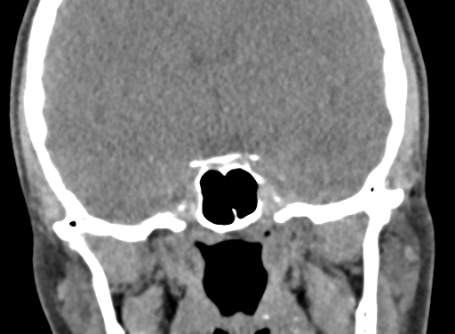 Angular dermoid cyst (Radiopaedia 88967-105790 Coronal non-contrast 62).jpg