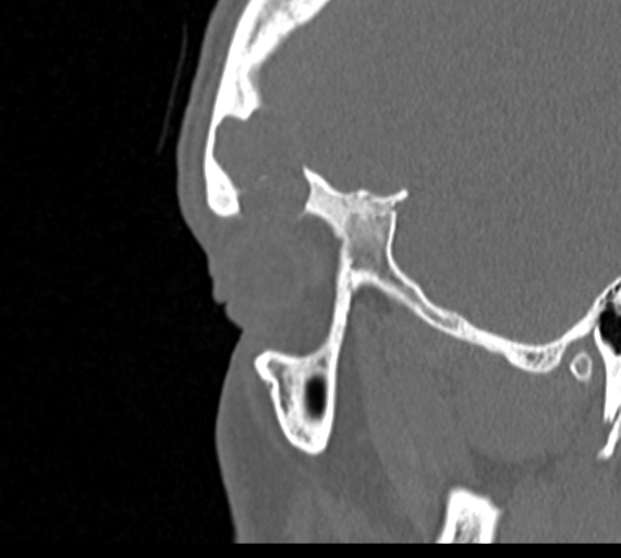 Angular epidermoid cyst (Radiopaedia 46908-51439 Sagittal bone window 83).png