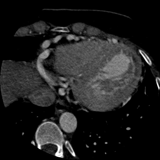 File:Anomalous left coronary artery from the pulmonary artery (ALCAPA) (Radiopaedia 40884-43586 A 69).jpg