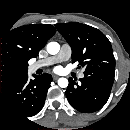 Anomalous left coronary artery from the pulmonary artery (ALCAPA) (Radiopaedia 70148-80181 A 20).jpg