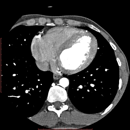 Anomalous left coronary artery from the pulmonary artery (ALCAPA) (Radiopaedia 70148-80181 A 254).jpg