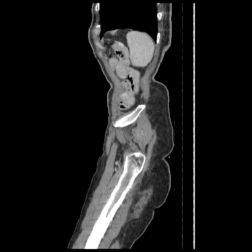 Anorectal carcinoma (Radiopaedia 44413-48064 C 102).jpg