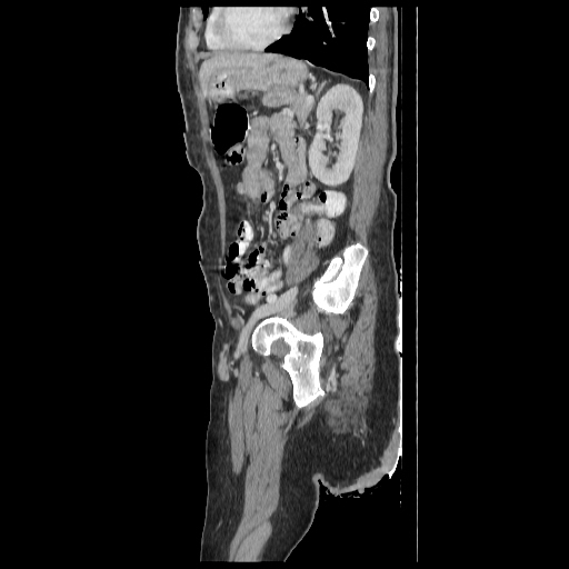 Anorectal carcinoma (Radiopaedia 44413-48064 C 76).jpg