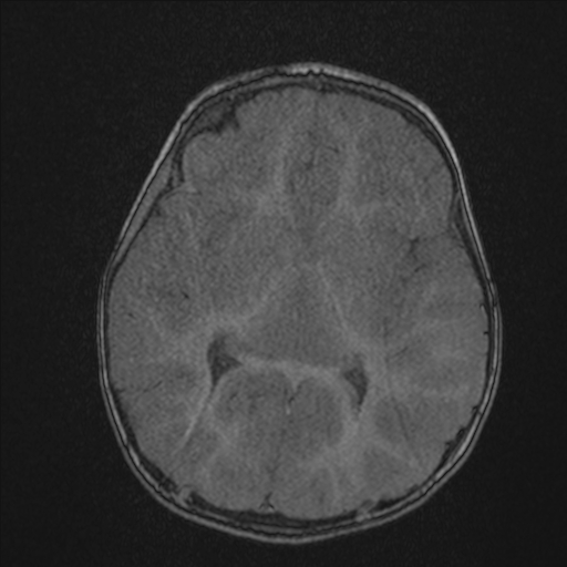 Anoxic brain injury (Radiopaedia 79165-92139 Axial MRA 123).jpg