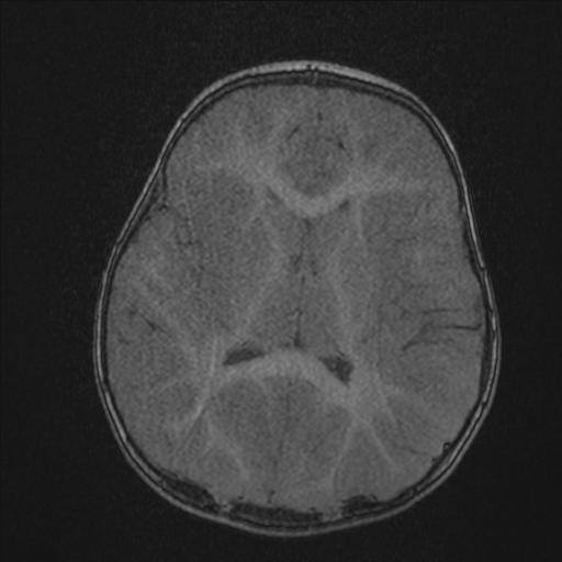 Anoxic brain injury (Radiopaedia 79165-92139 Axial MRA 143).jpg