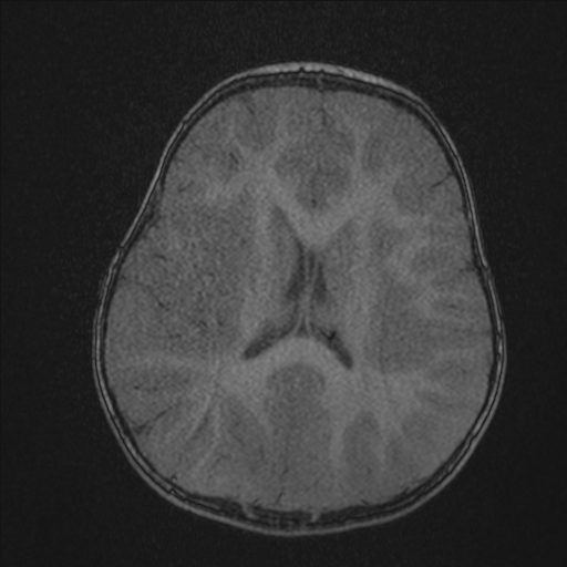 File:Anoxic brain injury (Radiopaedia 79165-92139 Axial MRA 157).jpg