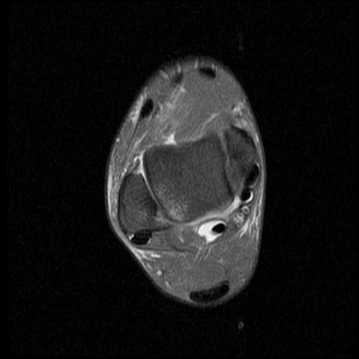 File:Anterior calcaneal process fracture (Radiopaedia 71377-81705 Axial PD fat sat 6).jpg