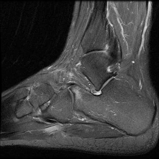 File:Anterior calcaneal process fracture (Radiopaedia 74654-85611 Sagittal PD fat sat 14).jpg