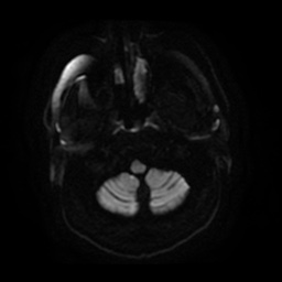 Anterior cerebral artery infarction (Radiopaedia 46794-51323 Axial DWI 4).jpg
